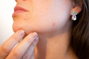 girl showing her acne pimple and redness on skin
