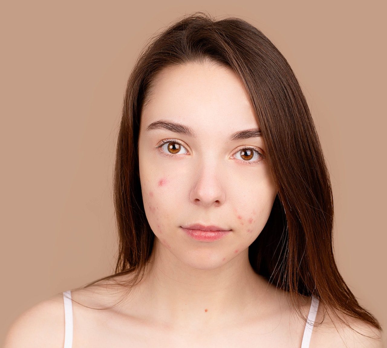 beautiful woman has acne on a skin